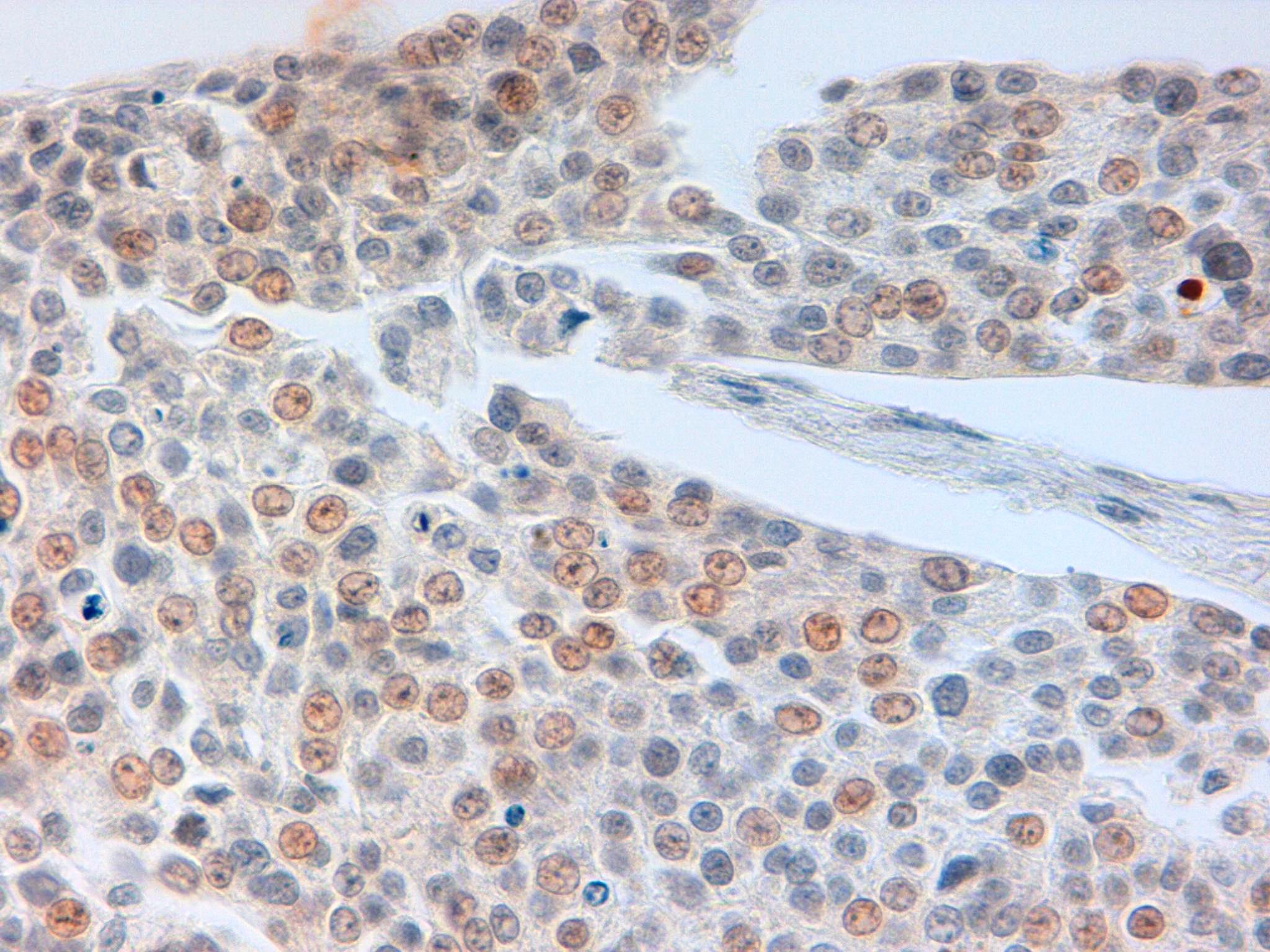 Immunohistochemical staining of FFPE human bladder tissue using phospho-Histone H2A.x (pS140) antibody at 5 µg/ml and antigen retrieval at pH 6.2.  Visualization using goat anti-rabbit HRP secondary antibody and DAB substrate.  Pathologists Comments: Good nuclear reactivity at pH 6.2 for bladder (very nice and clear).  We can confirm that nuclear activity is good and sharp.
